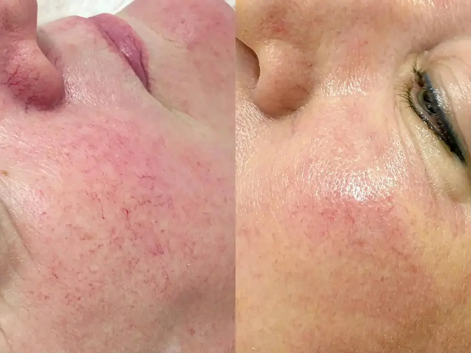 Glow beauty verisuonien hoito